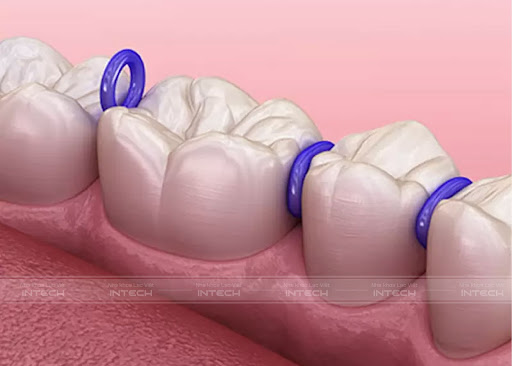 Đặt chun tách kẽ có thể gây cảm giác hơi khó chịu cho người niềng Đặt chun tách kẽ có thể gây cảm giác hơi khó chịu cho người niềng