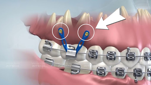Niềng răng có đau không? Cơ chế đau trong niềng răng 2 Minivis trong chỉnh nha là một thủ thuật mang đến nhiều lợi ích, tuy nhiên chúng có thể gây cảm giác đau cho khách hàng