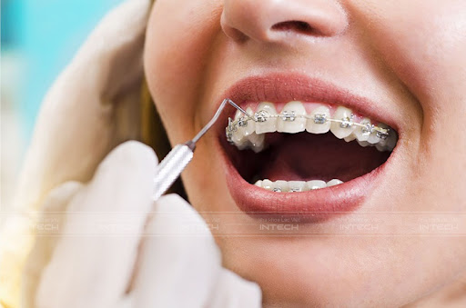 Niềng răng có đau không? Cơ chế đau trong niềng răng 3 Thời gian đầu gắn mắc cài hoặc các lần siết răng định kỳ có thể khiến bạn cảm thấy hơi ê nhức