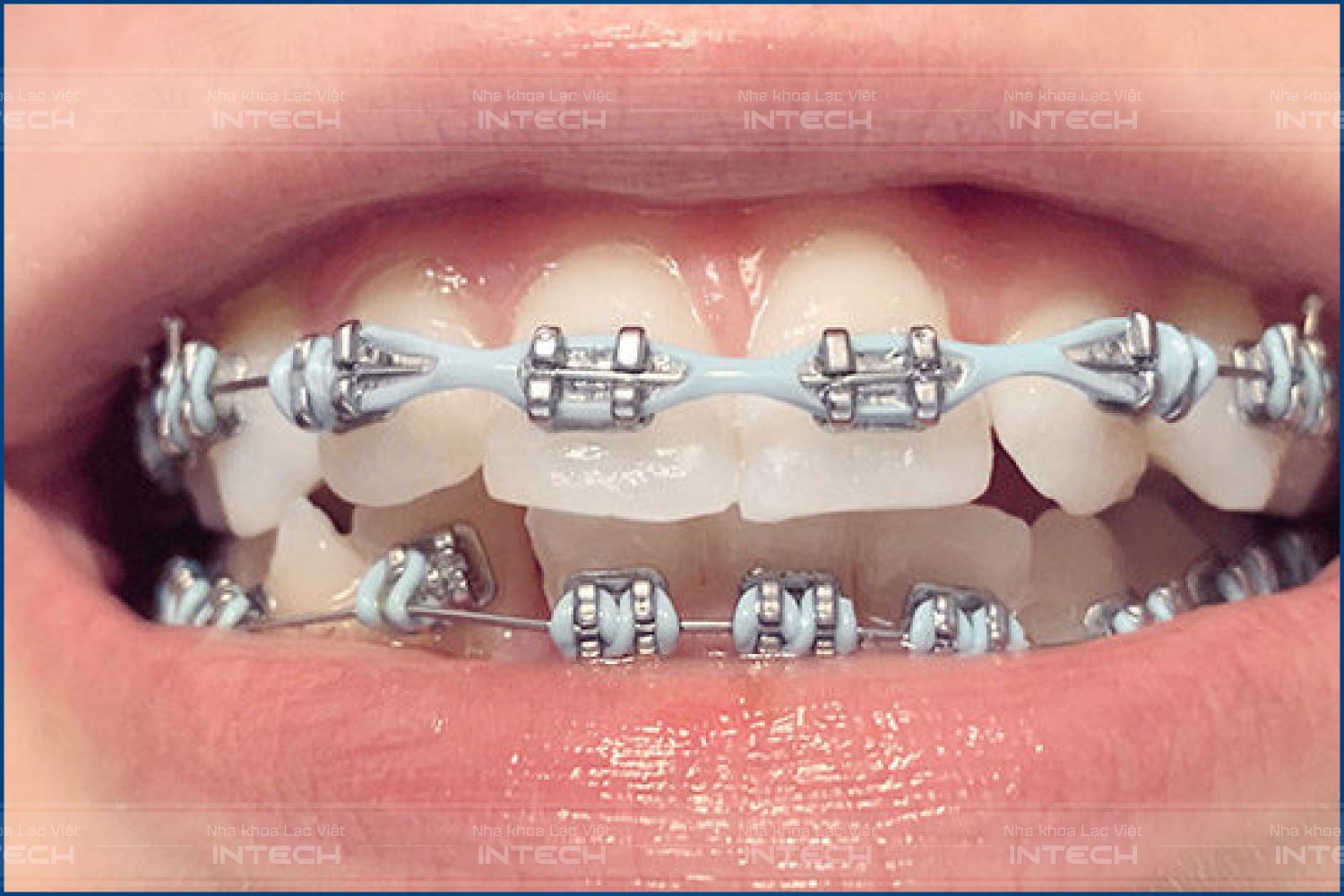 Thun chuỗi tác động lực dàn đều răng trong trường hợp sai lệch nhiều