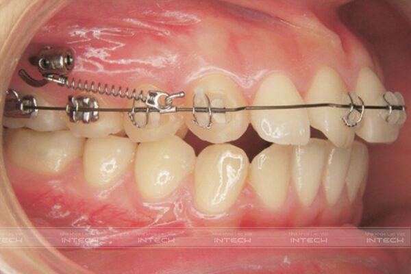 Bác sĩ có thể áp sử dụng minivis để di xa toàn hàm thay thế phương pháp nhổ răng