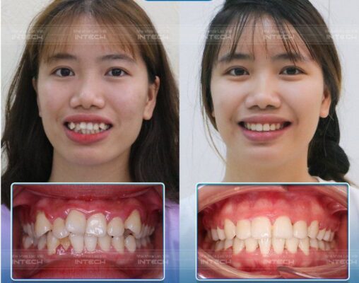 Niềng răng giúp khắc phục các sai lệch răng 