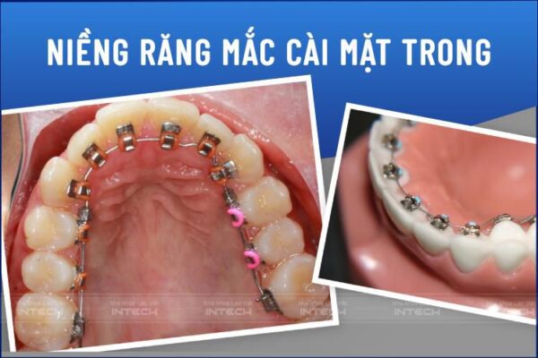 bang gia nieng rang mac cai kim loai hai phong 4