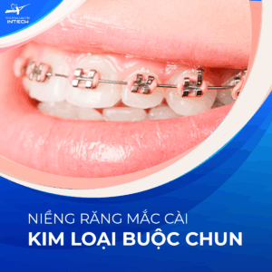 Mắc cài kim loại buộc chun