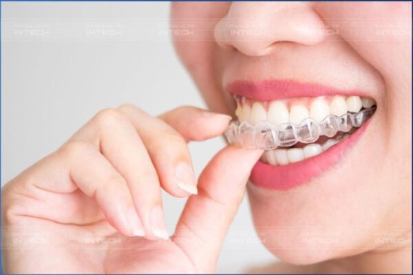 Bảng giá niềng răng mắc cài trong suốt tại Vinh - Nghệ An mới nhất 1 nieng rang trong suot hieu qua khong 600x400 3
