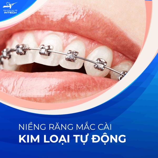 Mắc cài kim loại tự động