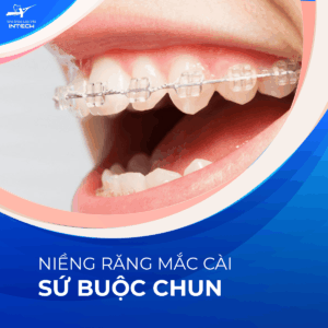 Mắc cài sứ buộc chun