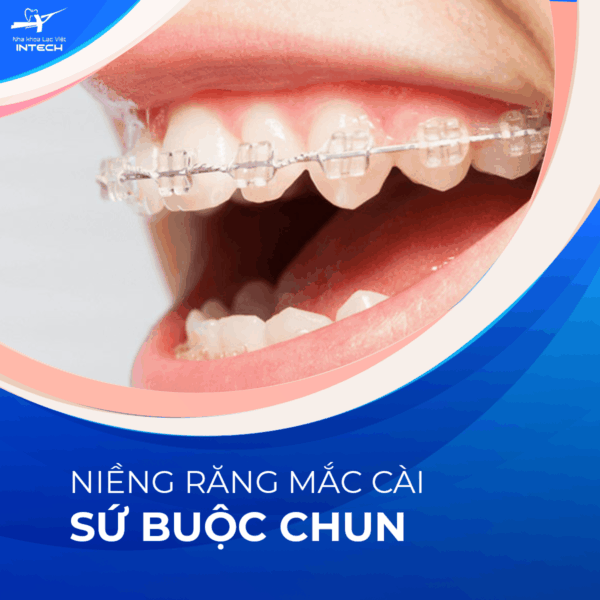 Mắc cài sứ buộc chun
