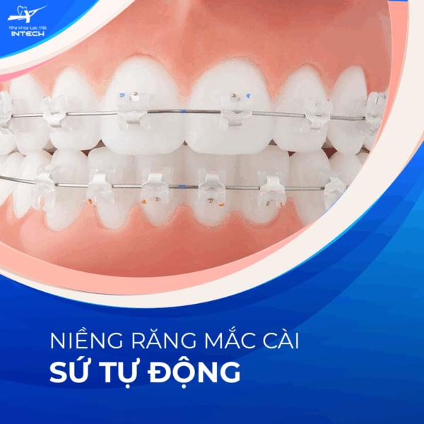 Mắc cài sứ tự động