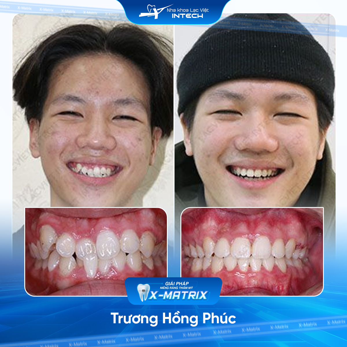 Bác sĩ niềng răng Cao Linh | Thông Tin - Đặt Lịch Bác Sĩ 23 Bac si nieng rang Cao Linh nha khoa Lac Viet Intech