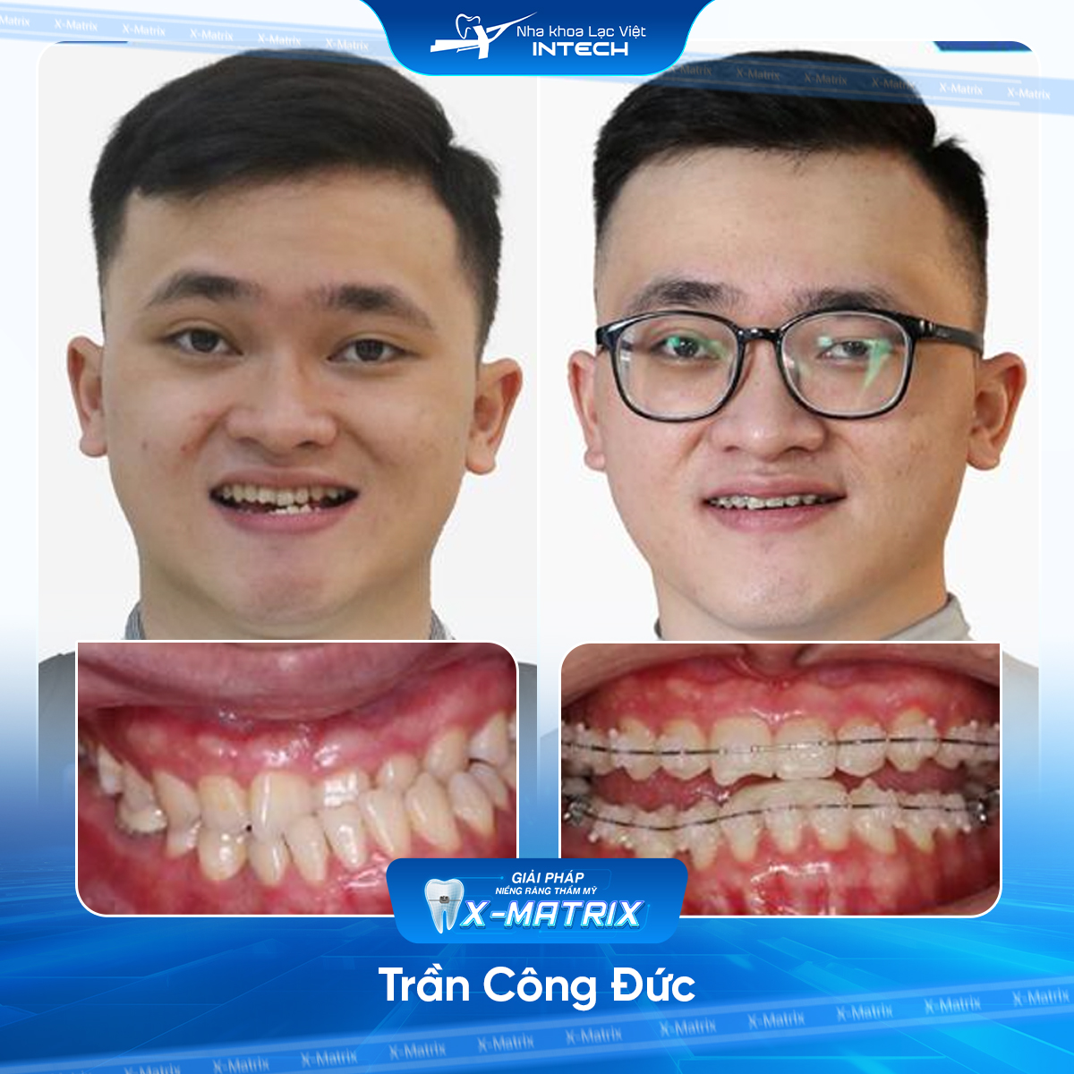 Bác sĩ niềng răng Cao Linh | Thông Tin - Đặt Lịch Bác Sĩ 14 Bac si nieng rang Cao Linh nha khoa Lac Viet Intech