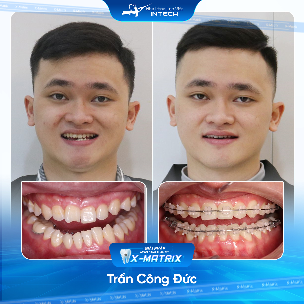 Bác sĩ niềng răng Cao Linh | Thông Tin - Đặt Lịch Bác Sĩ 13 Bac si nieng rang Cao Linh nha khoa Lac Viet Intech