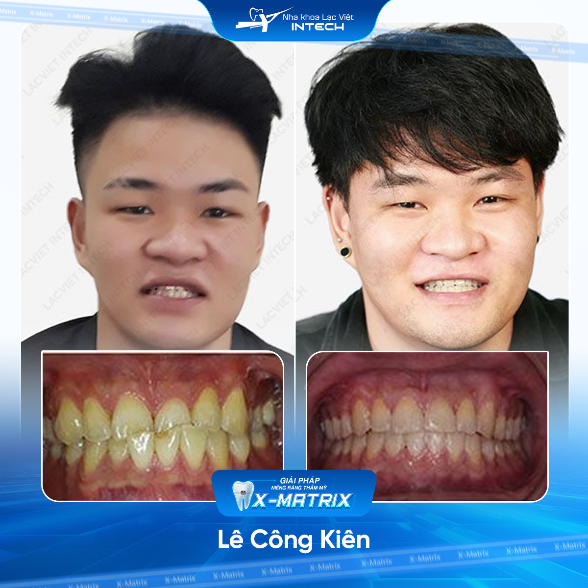 Bác sĩ niềng răng Cao Linh | Thông Tin - Đặt Lịch Bác Sĩ 12 Bac si nieng rang Cao Linh nha khoa Lac Viet Intech