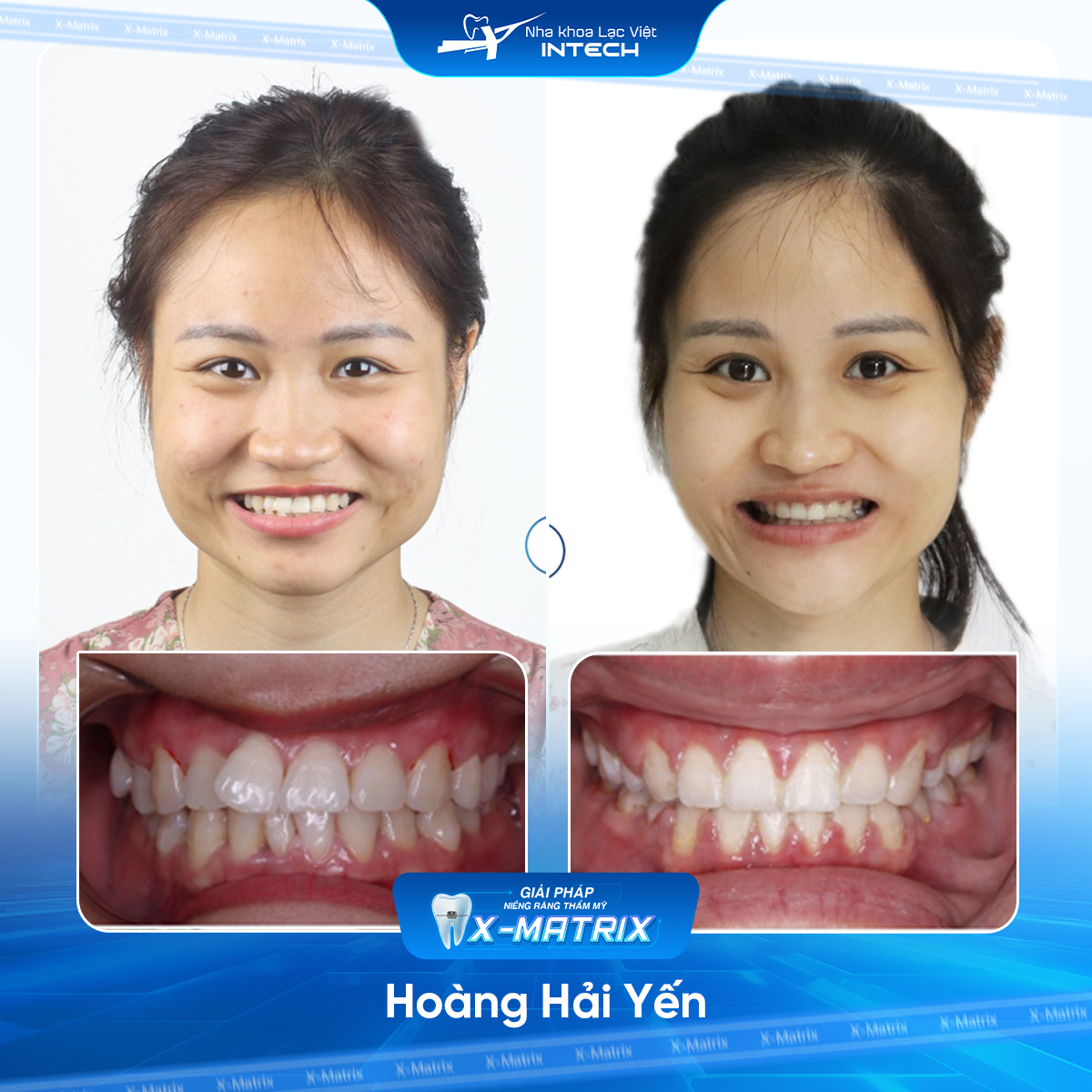 Bác sĩ niềng răng Cao Linh | Thông Tin - Đặt Lịch Bác Sĩ 9 Bac si nieng rang Cao Linh nha khoa Lac Viet Intech