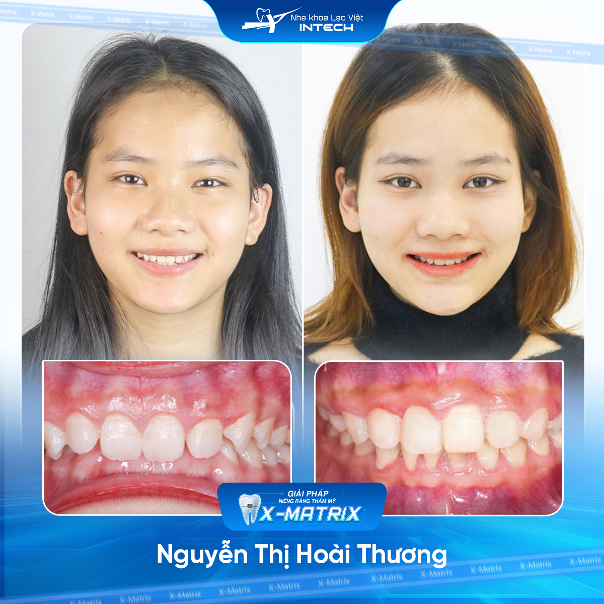 Bác sĩ niềng răng Cao Linh | Thông Tin - Đặt Lịch Bác Sĩ 8 Bac si nieng rang Cao Linh nha khoa Lac Viet Intech