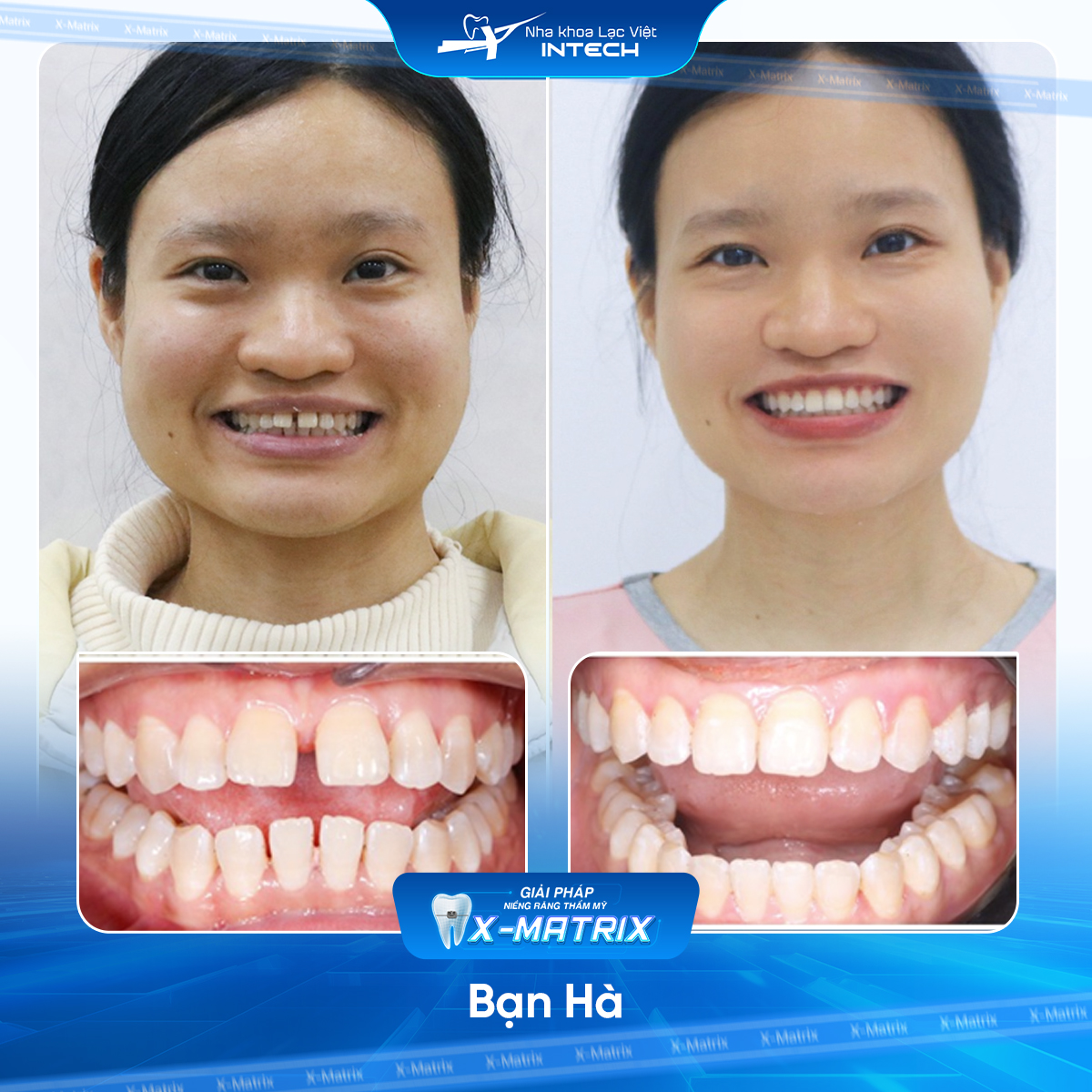 Bác sĩ niềng răng Cao Linh | Thông Tin - Đặt Lịch Bác Sĩ 22 Bac si nieng rang Cao Linh nha khoa Lac Viet Intech