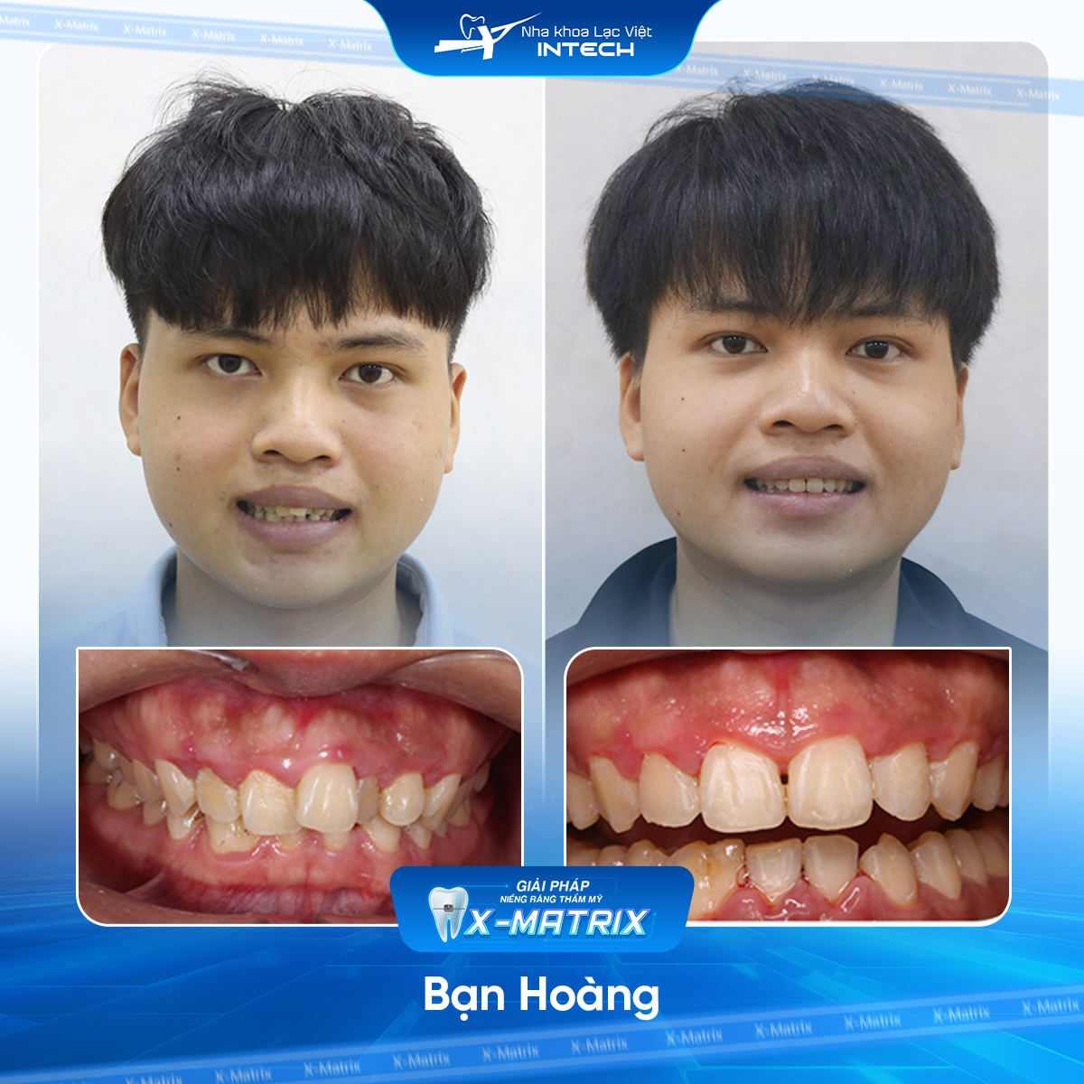 Bác sĩ niềng răng Cao Linh | Thông Tin - Đặt Lịch Bác Sĩ 21 Bac si nieng rang Cao Linh nha khoa Lac Viet Intech