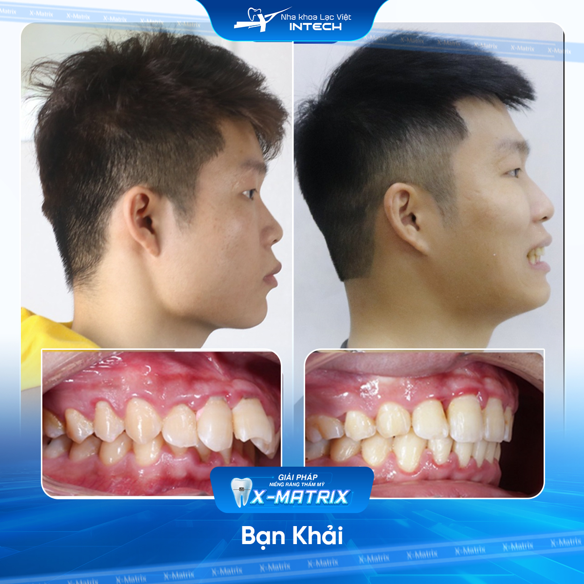 Bác sĩ niềng răng Cao Linh | Thông Tin - Đặt Lịch Bác Sĩ 20 Bac si nieng rang Cao Linh nha khoa Lac Viet Intech