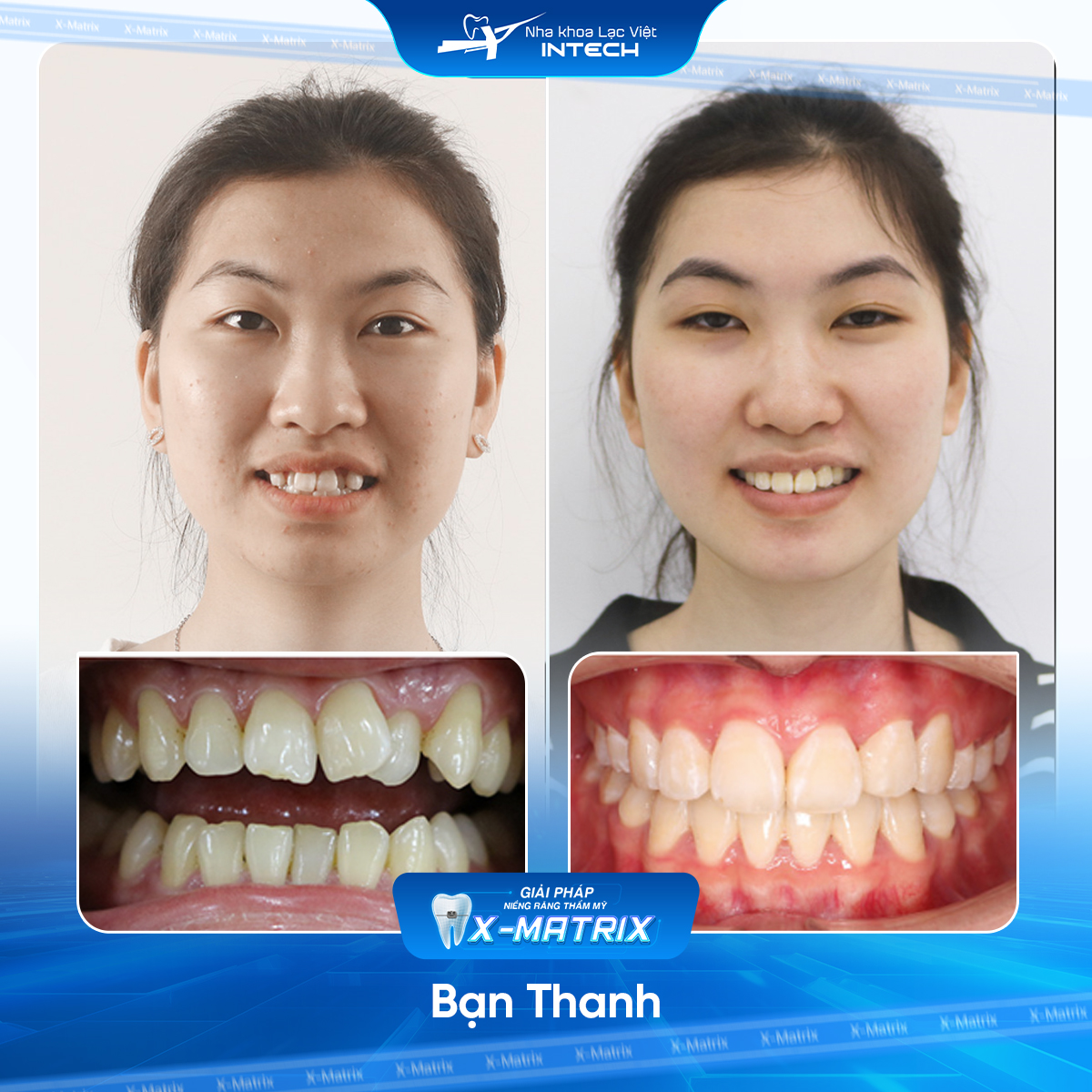 Bác sĩ niềng răng Cao Linh | Thông Tin - Đặt Lịch Bác Sĩ 19 Bac si nieng rang Cao Linh nha khoa Lac Viet Intech