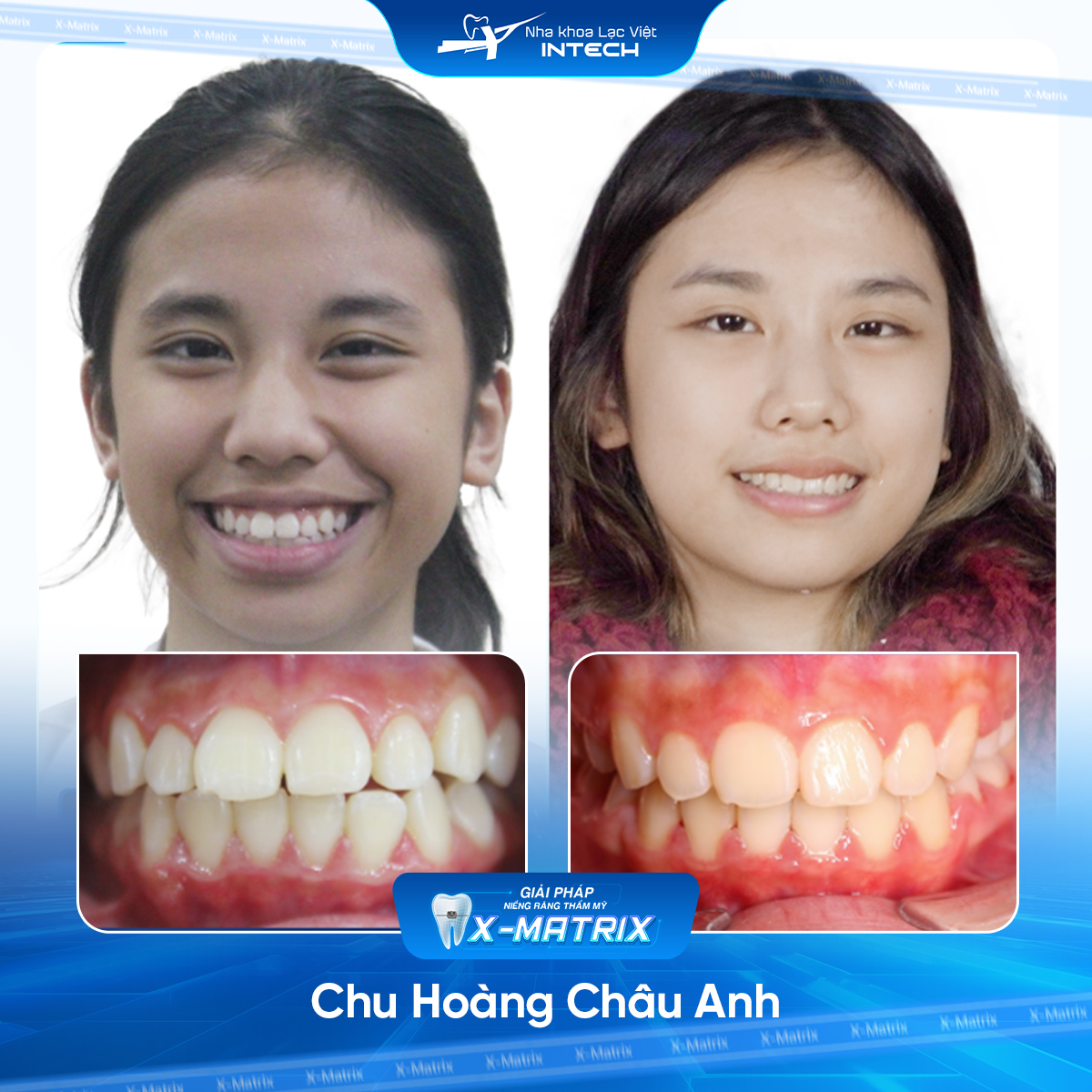 Bác sĩ niềng răng Cao Linh | Thông Tin - Đặt Lịch Bác Sĩ 15 Bac si nieng rang Cao Linh nha khoa Lac Viet Intech
