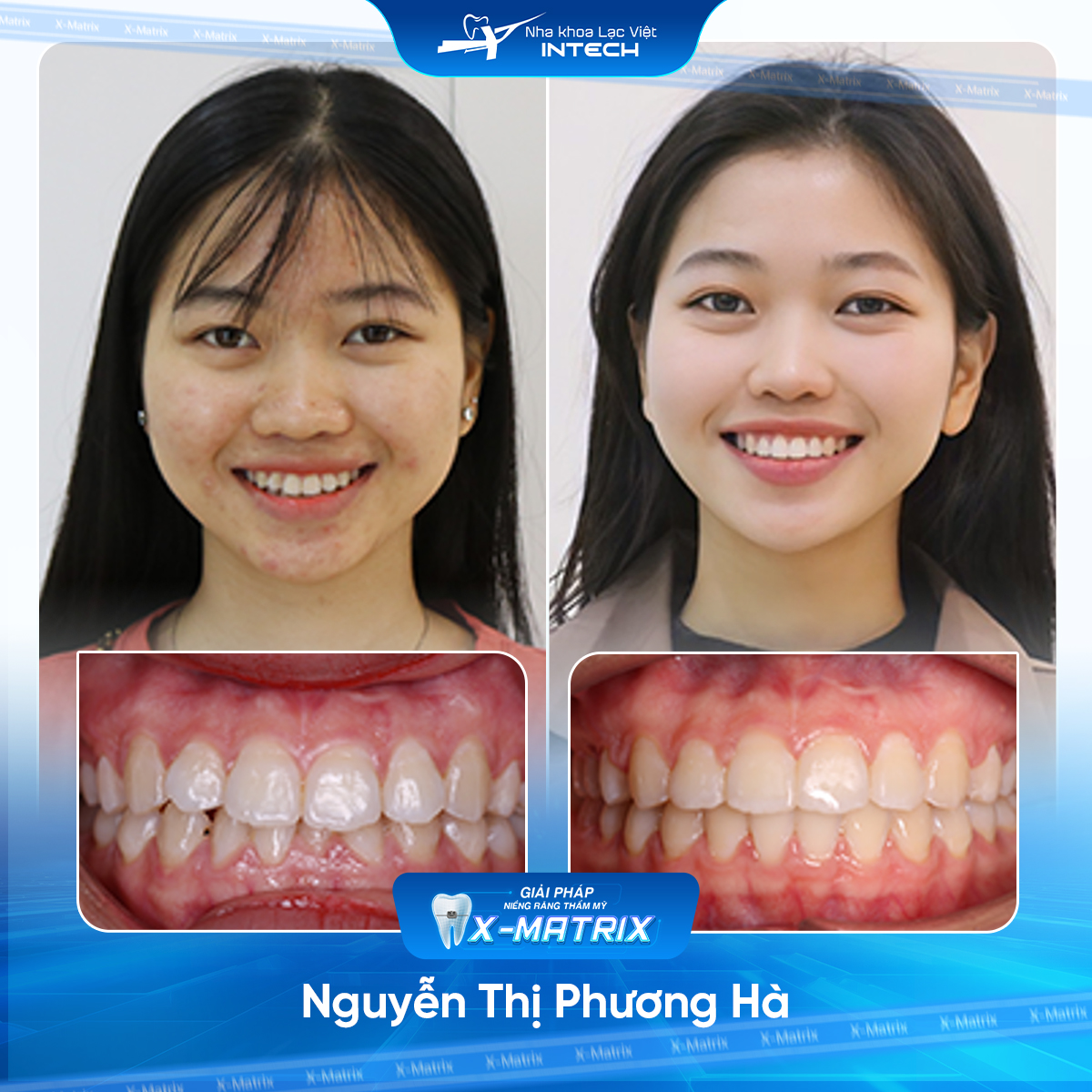 Bác sĩ niềng răng Lan Anh | Thông Tin - Đặt Lịch Bác Sĩ 7 Bac si nieng rang Lan Anh nha khoa Lac Viet Intech