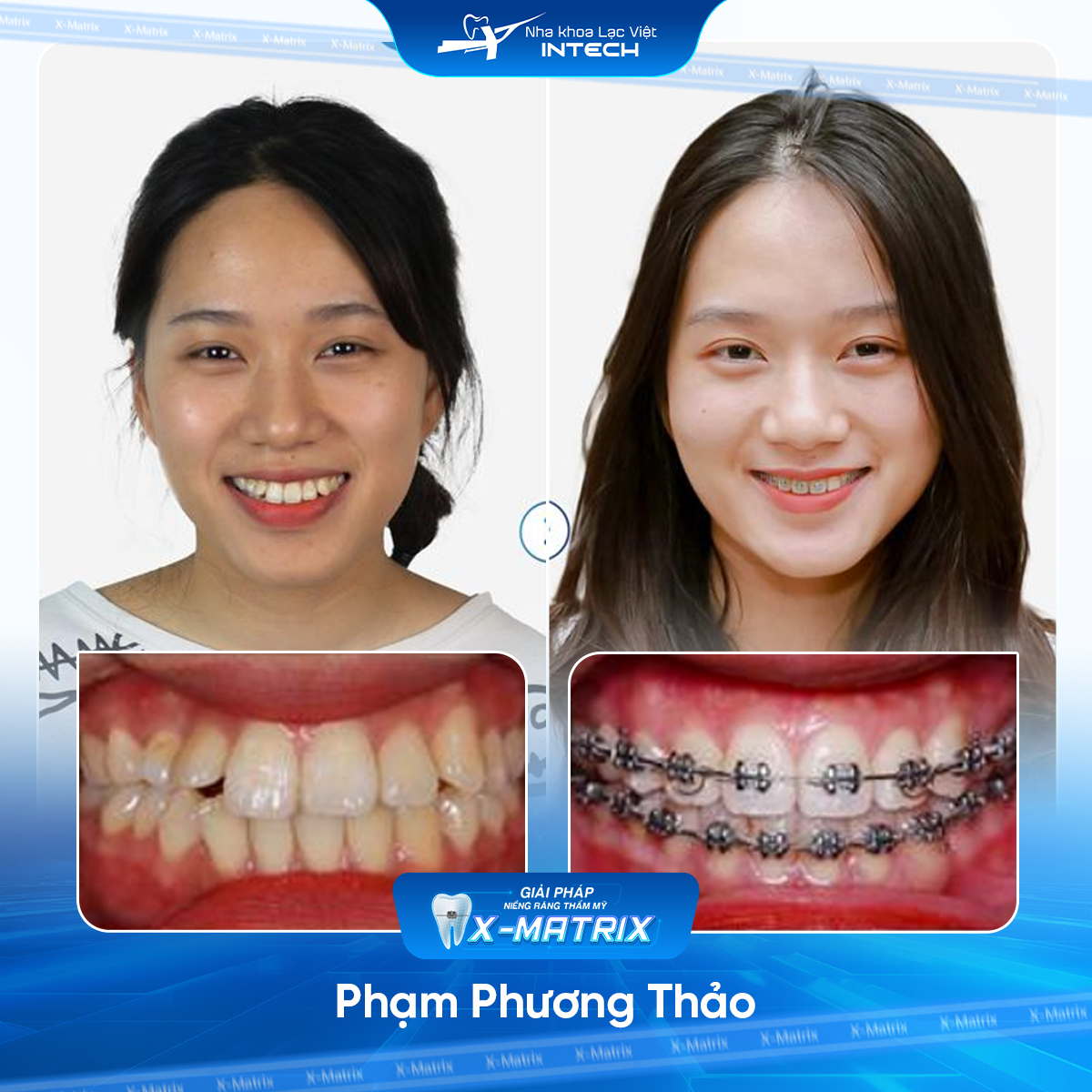 Bác sĩ niềng răng Lan Anh | Thông Tin - Đặt Lịch Bác Sĩ 8 Bac si nieng rang Lan Anh nha khoa Lac Viet Intech