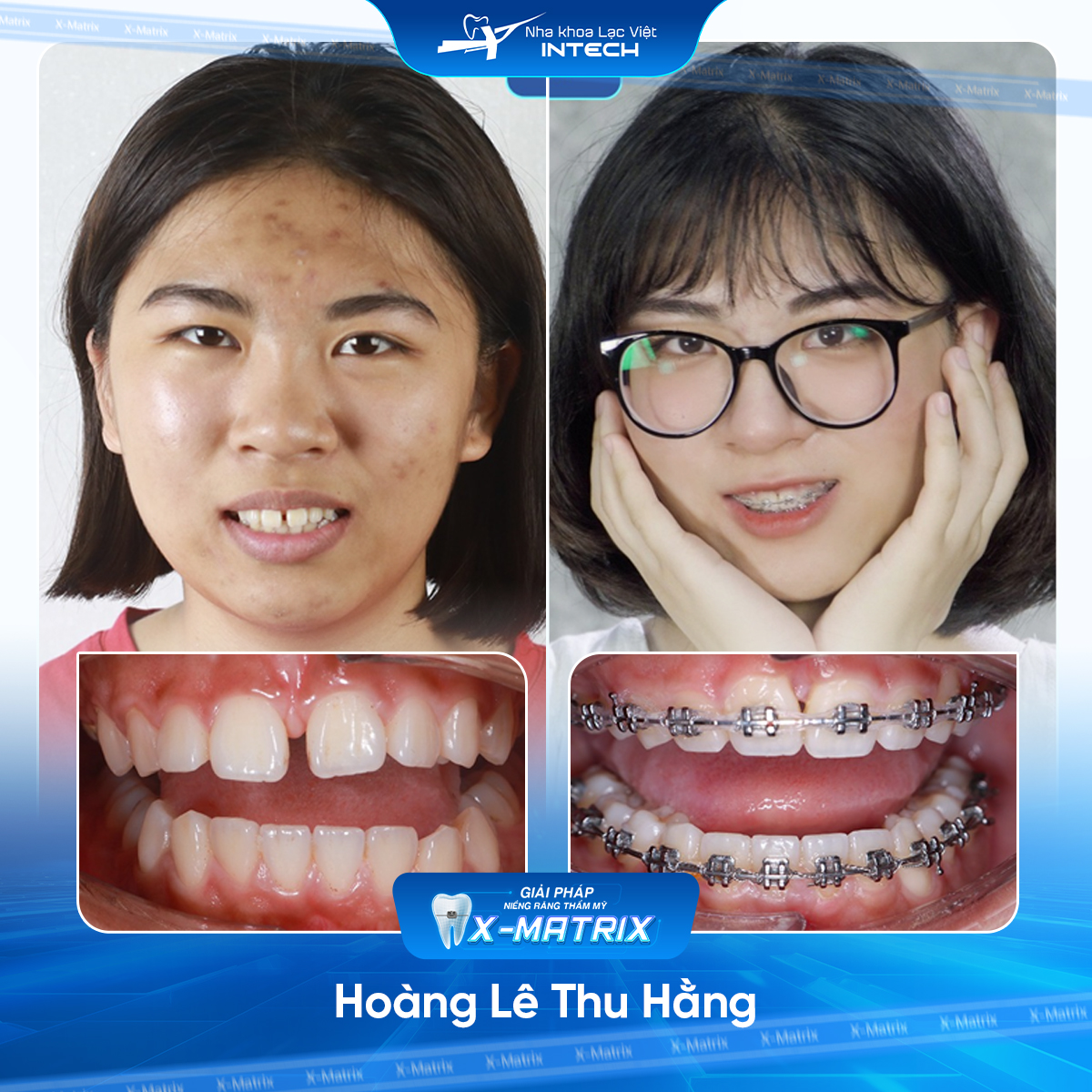 Bác sĩ niềng răng Lan Anh | Thông Tin - Đặt Lịch Bác Sĩ 9 Bac si nieng rang Lan Anh nha khoa Lac Viet Intech