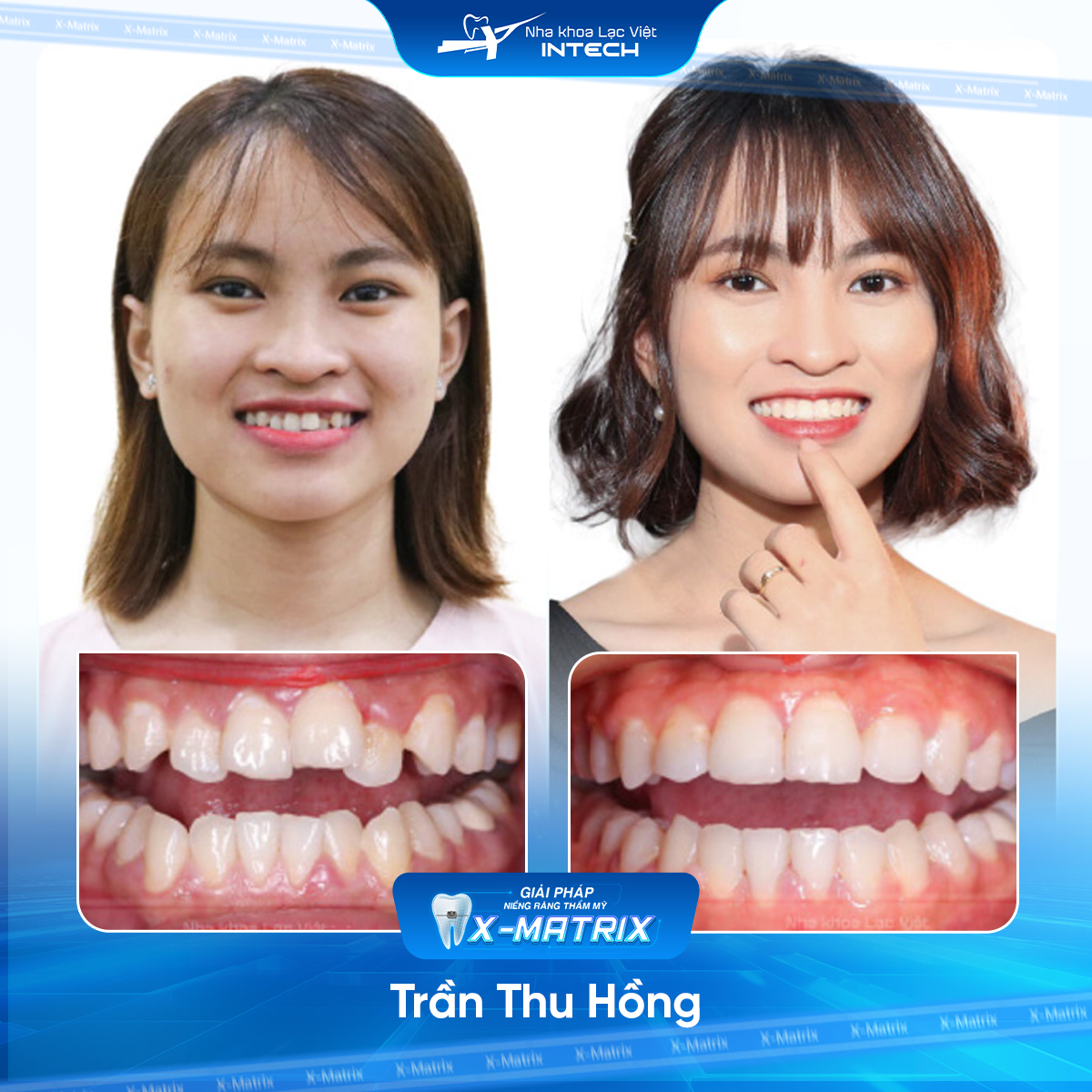 Bác sĩ niềng răng Lan Anh | Thông Tin - Đặt Lịch Bác Sĩ 10 Bac si nieng rang Lan Anh nha khoa Lac Viet Intech