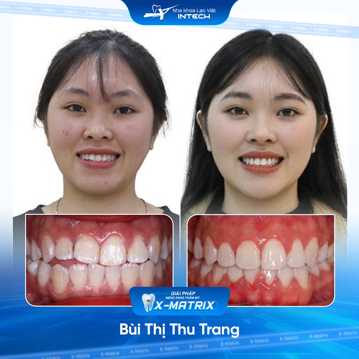 Bác sĩ niềng răng Lan Anh | Thông Tin - Đặt Lịch Bác Sĩ 11 Bac si nieng rang Lan Anh nha khoa Lac Viet Intech