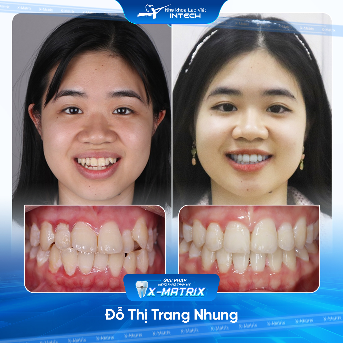 Bác sĩ niềng răng Lan Anh | Thông Tin - Đặt Lịch Bác Sĩ 12 Bac si nieng rang Lan Anh nha khoa Lac Viet Intech