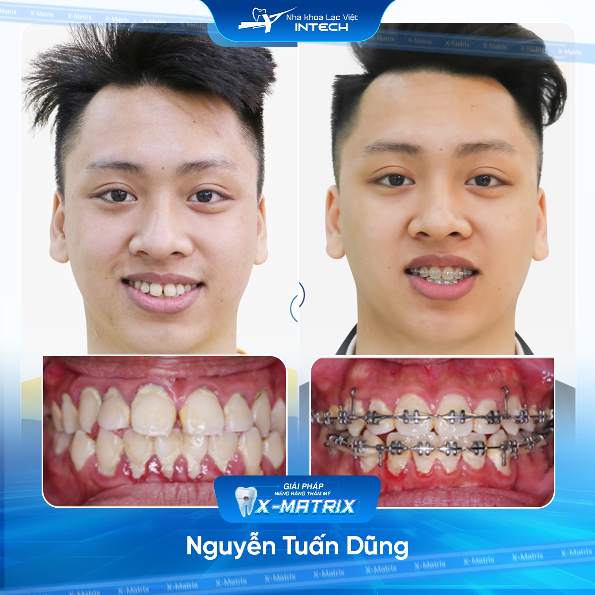 Bác sĩ niềng răng Lan Anh | Thông Tin - Đặt Lịch Bác Sĩ 13 Bac si nieng rang Lan Anh nha khoa Lac Viet Intech