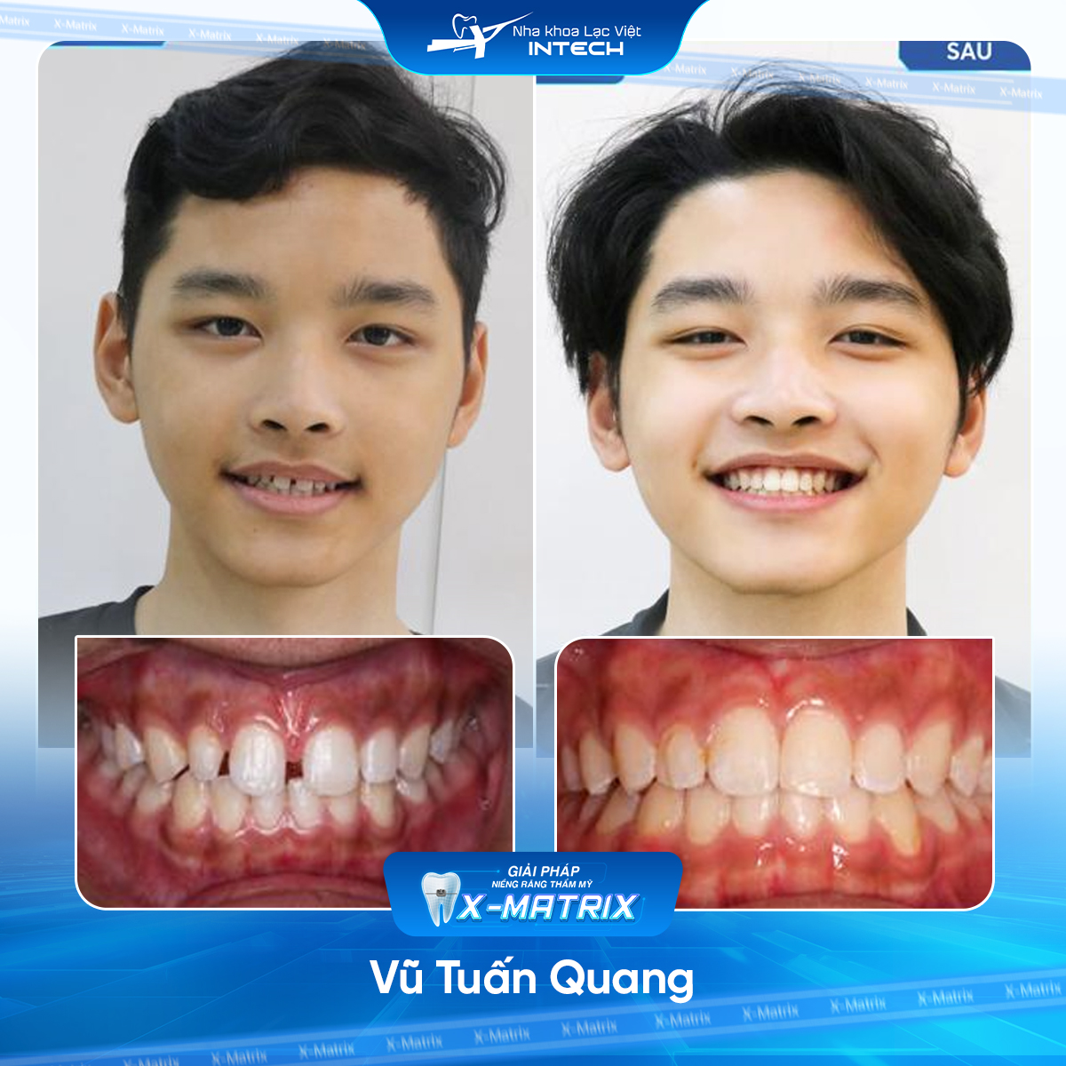 Bác sĩ niềng răng Lan Anh | Thông Tin - Đặt Lịch Bác Sĩ 14 Bac si nieng rang Lan Anh nha khoa Lac Viet Intech
