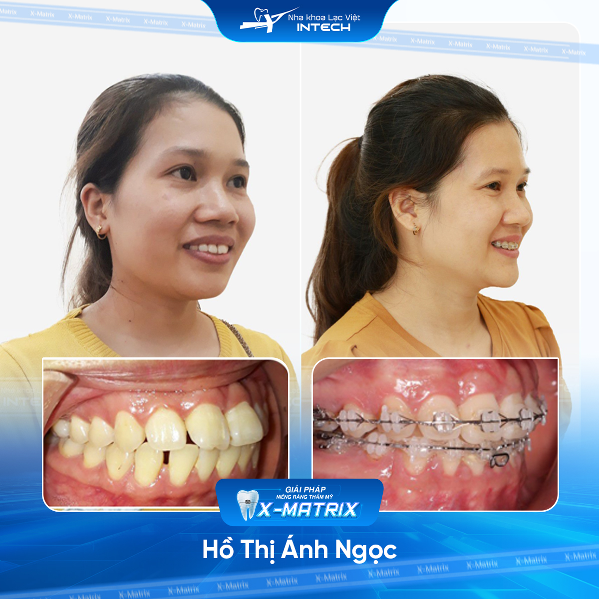 Bac si nieng rang Mai Anh nha khoa Lac Viet Intech