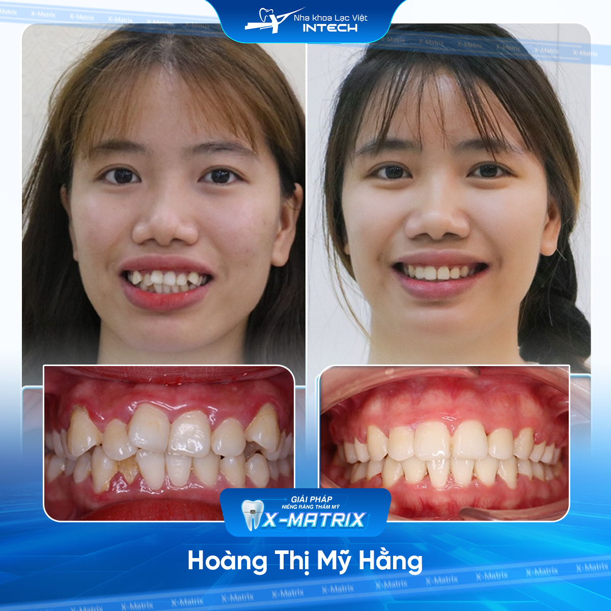 Bac si nieng rang Mai Anh nha khoa Lac Viet Intech