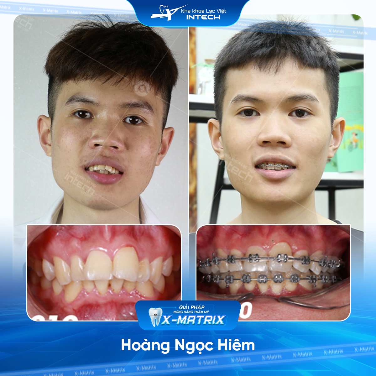 Bac si nieng rang Mai Anh nha khoa Lac Viet Intech