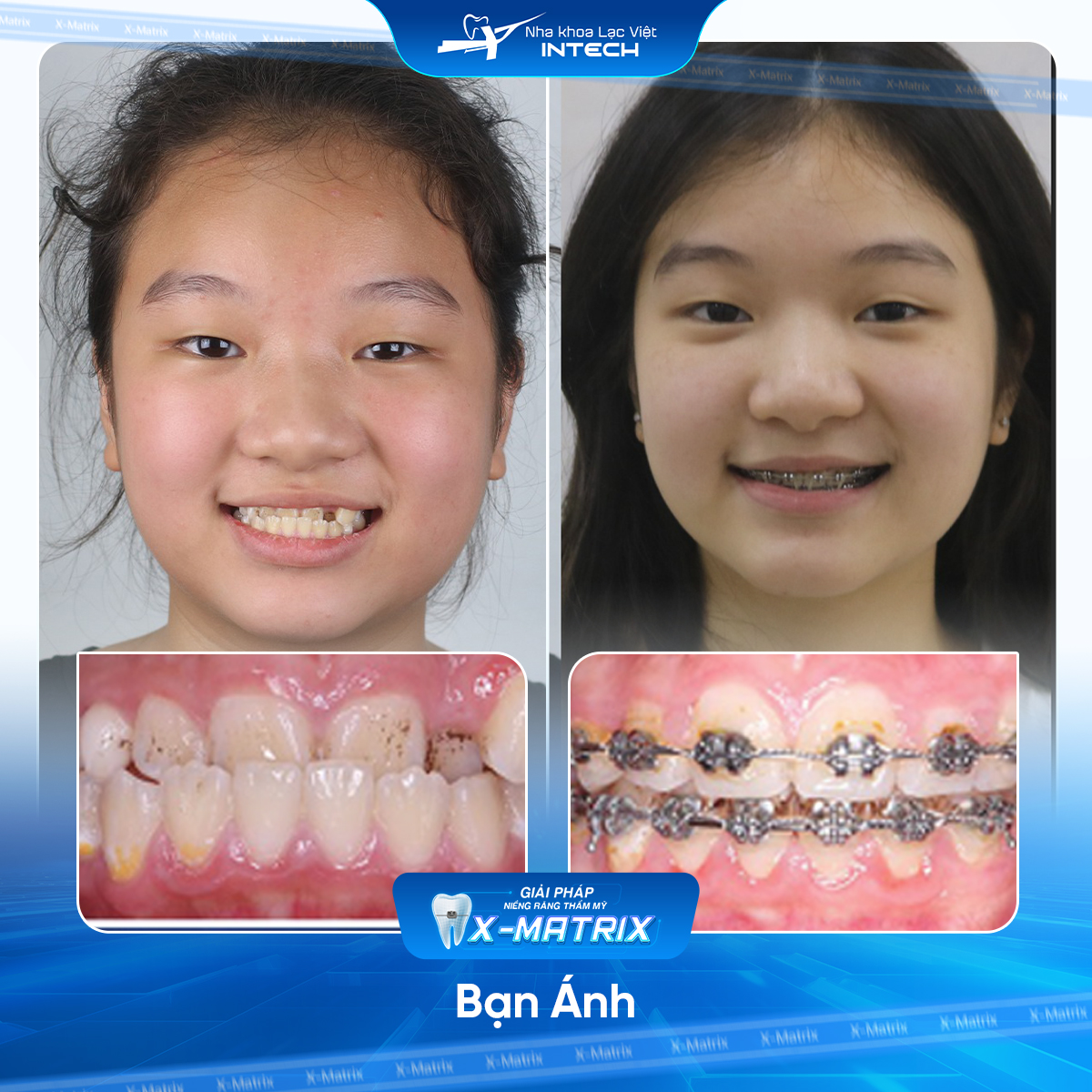 Bac si nieng rang Mai Anh nha khoa Lac Viet Intech