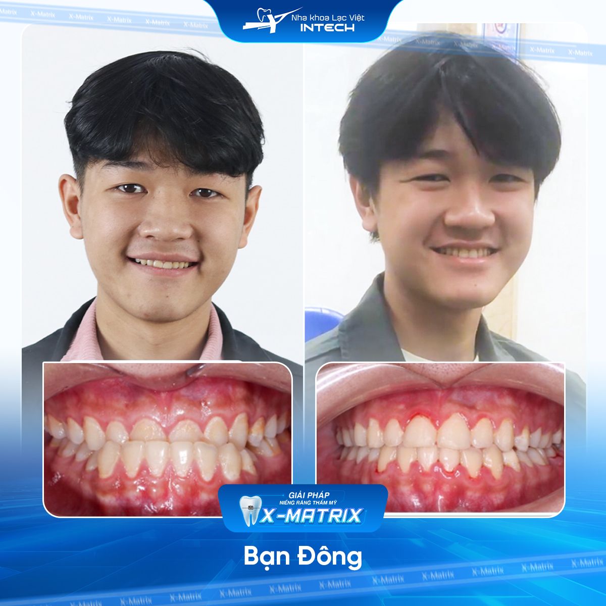 Bac si nieng rang Mai Anh nha khoa Lac Viet Intech