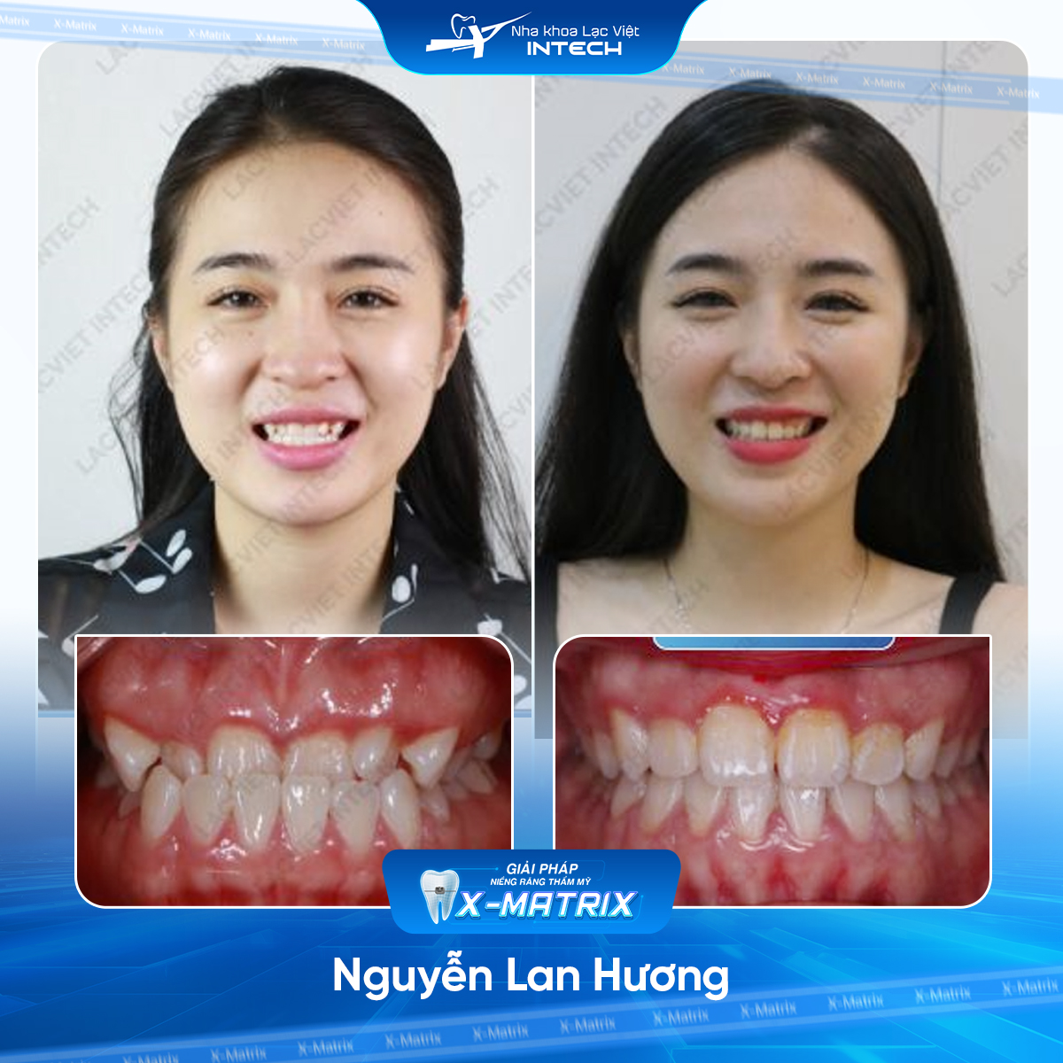 Bac si nieng rang Mai Anh nha khoa Lac Viet Intech