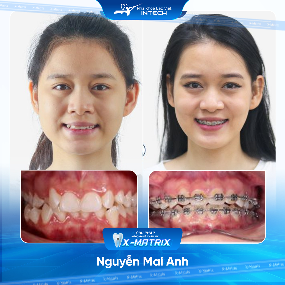 Bac si nieng rang Mai Anh nha khoa Lac Viet Intech