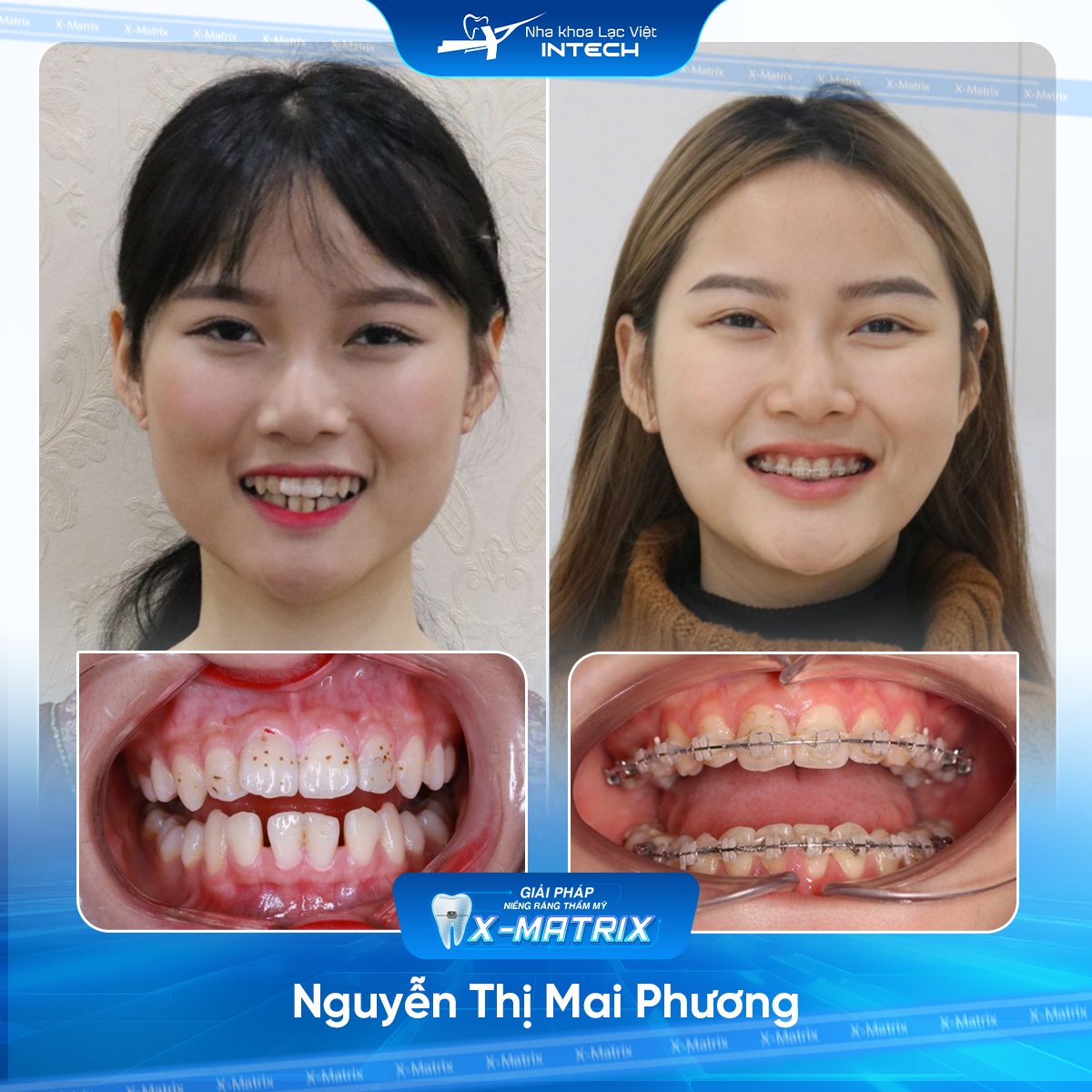 Bac si nieng rang Mai Anh nha khoa Lac Viet Intech