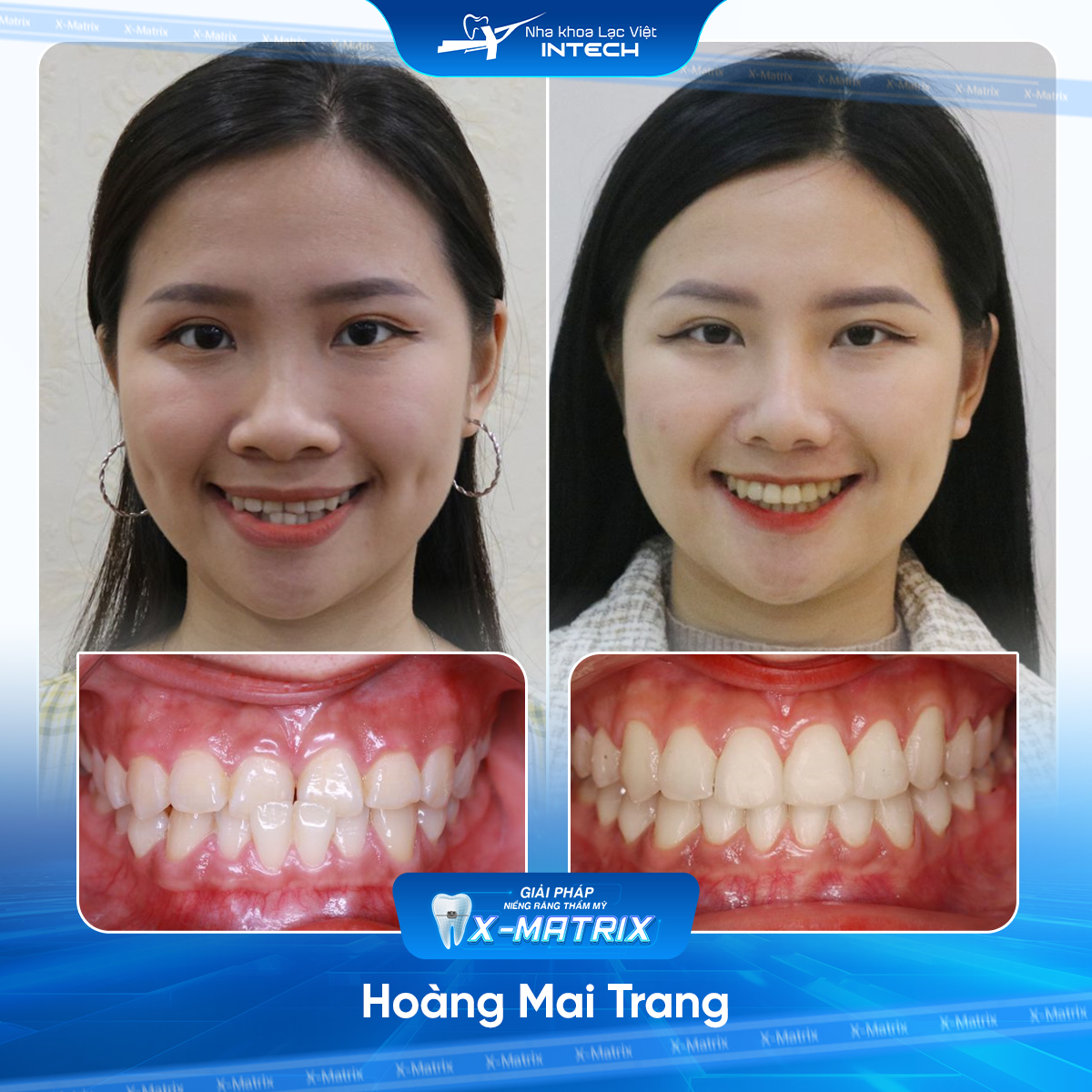 Bac si nieng rang Mai Anh nha khoa Lac Viet Intech