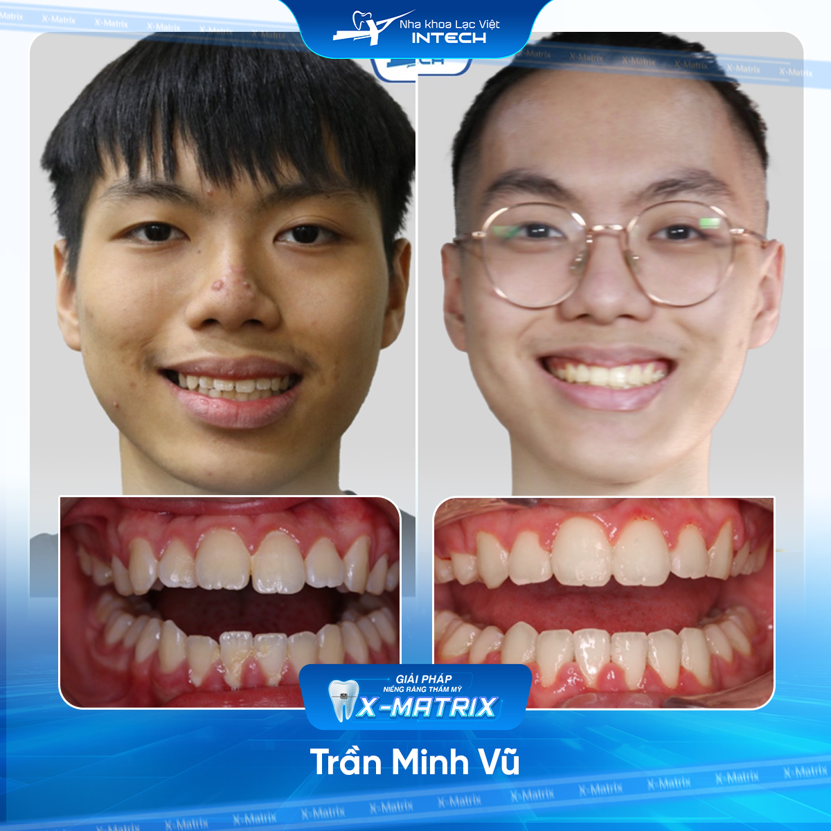 Bac si nieng rang Mai Anh nha khoa Lac Viet Intech