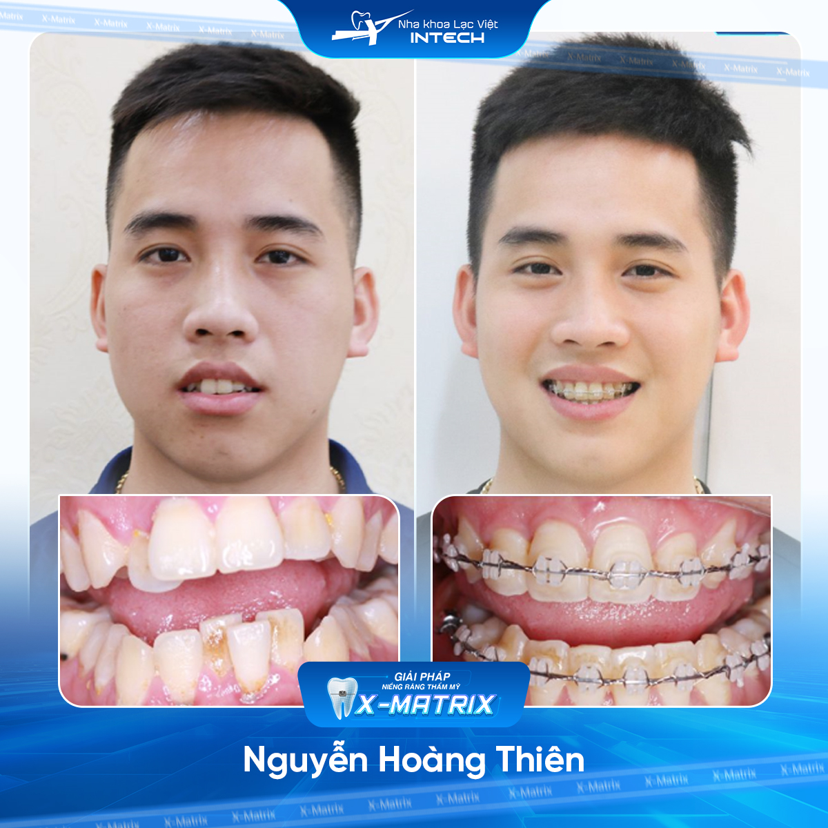 Bác sĩ niềng răng Phạm Dung | Thông Tin - Đặt Lịch Bác Sĩ 19 Bac si nieng rang Pham Dung nha khoa Lac Viet Intech