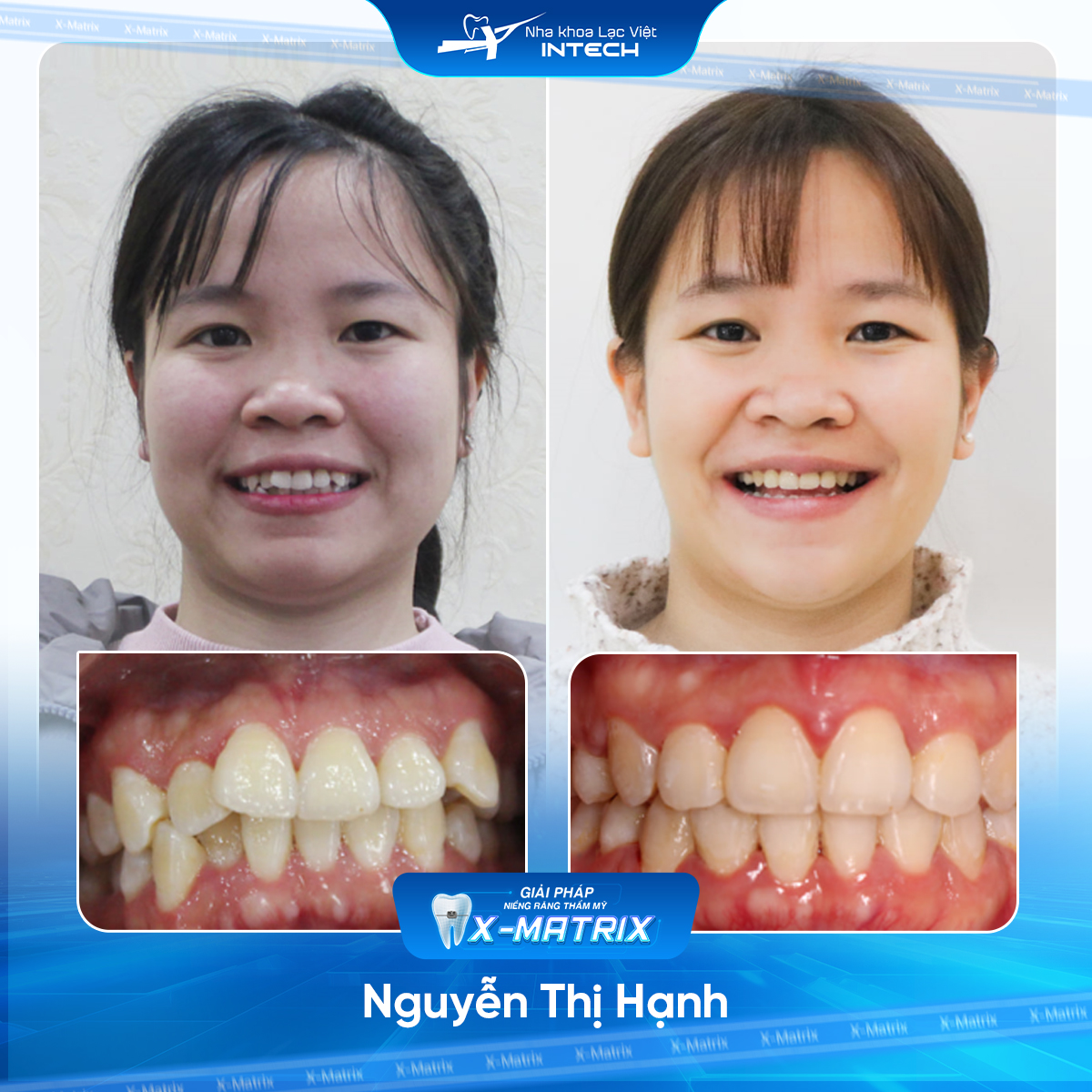 Bác sĩ niềng răng Phạm Dung | Thông Tin - Đặt Lịch Bác Sĩ 10 Bac si nieng rang Pham Dung nha khoa Lac Viet Intech