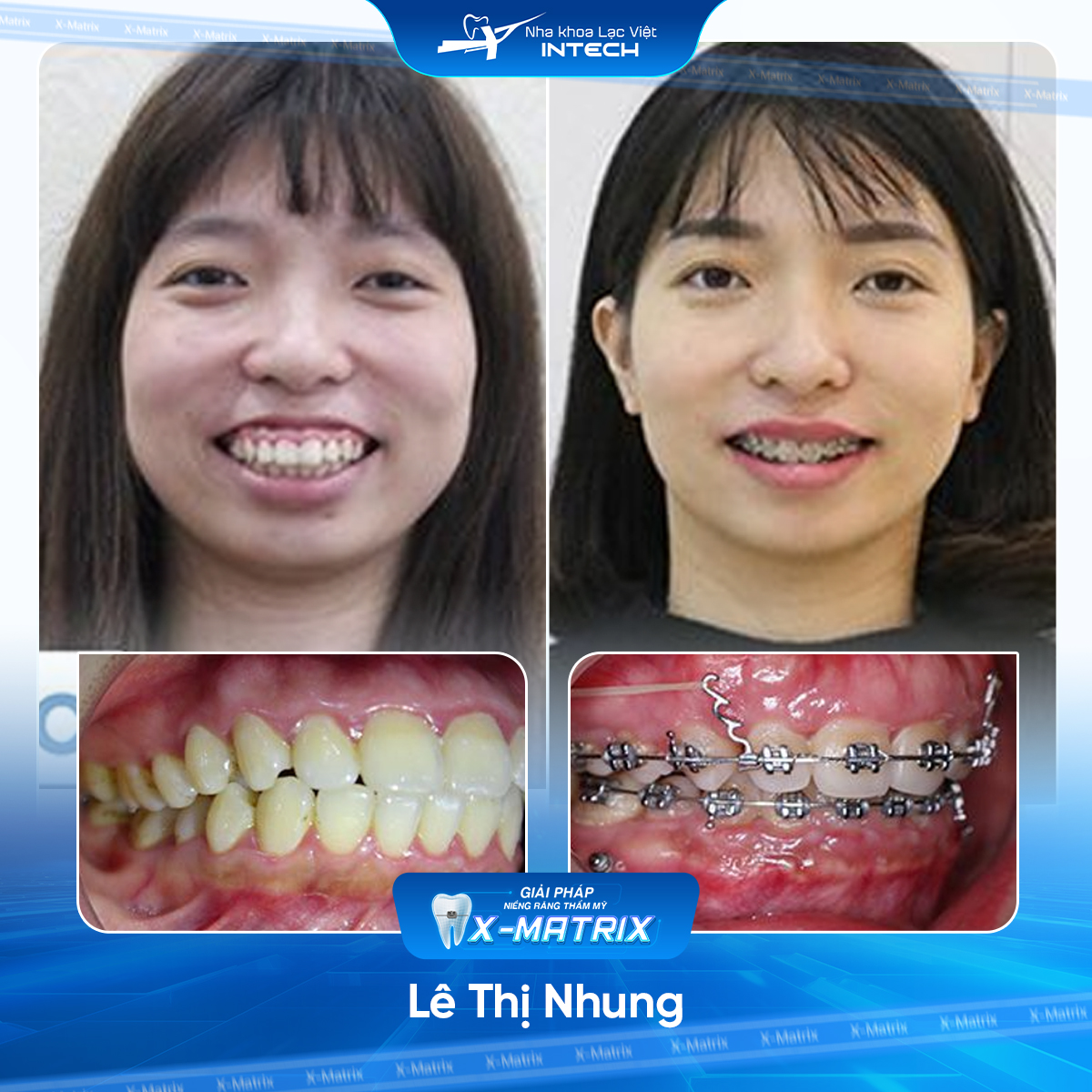 Bác sĩ niềng răng Phạm Dung | Thông Tin - Đặt Lịch Bác Sĩ 9 Bac si nieng rang Pham Dung nha khoa Lac Viet Intech