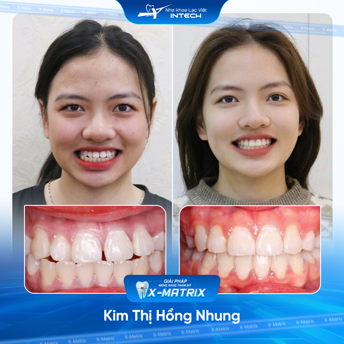 Bác sĩ niềng răng Phạm Dung | Thông Tin - Đặt Lịch Bác Sĩ 18 Bac si nieng rang Pham Dung nha khoa Lac Viet Intech