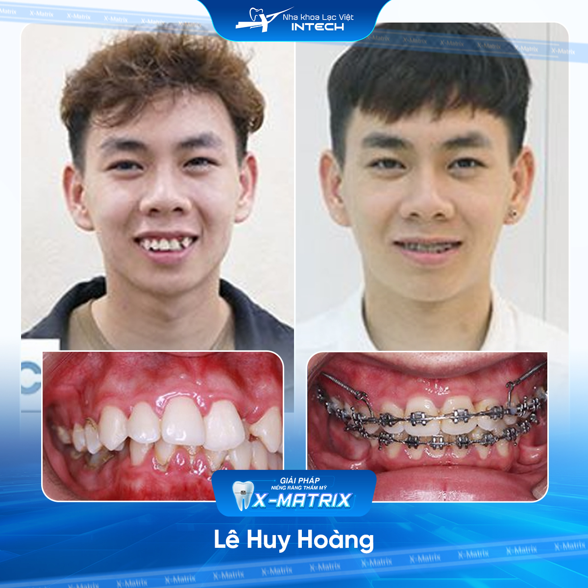Bác sĩ niềng răng Phạm Dung | Thông Tin - Đặt Lịch Bác Sĩ 17 Bac si nieng rang Pham Dung nha khoa Lac Viet Intech