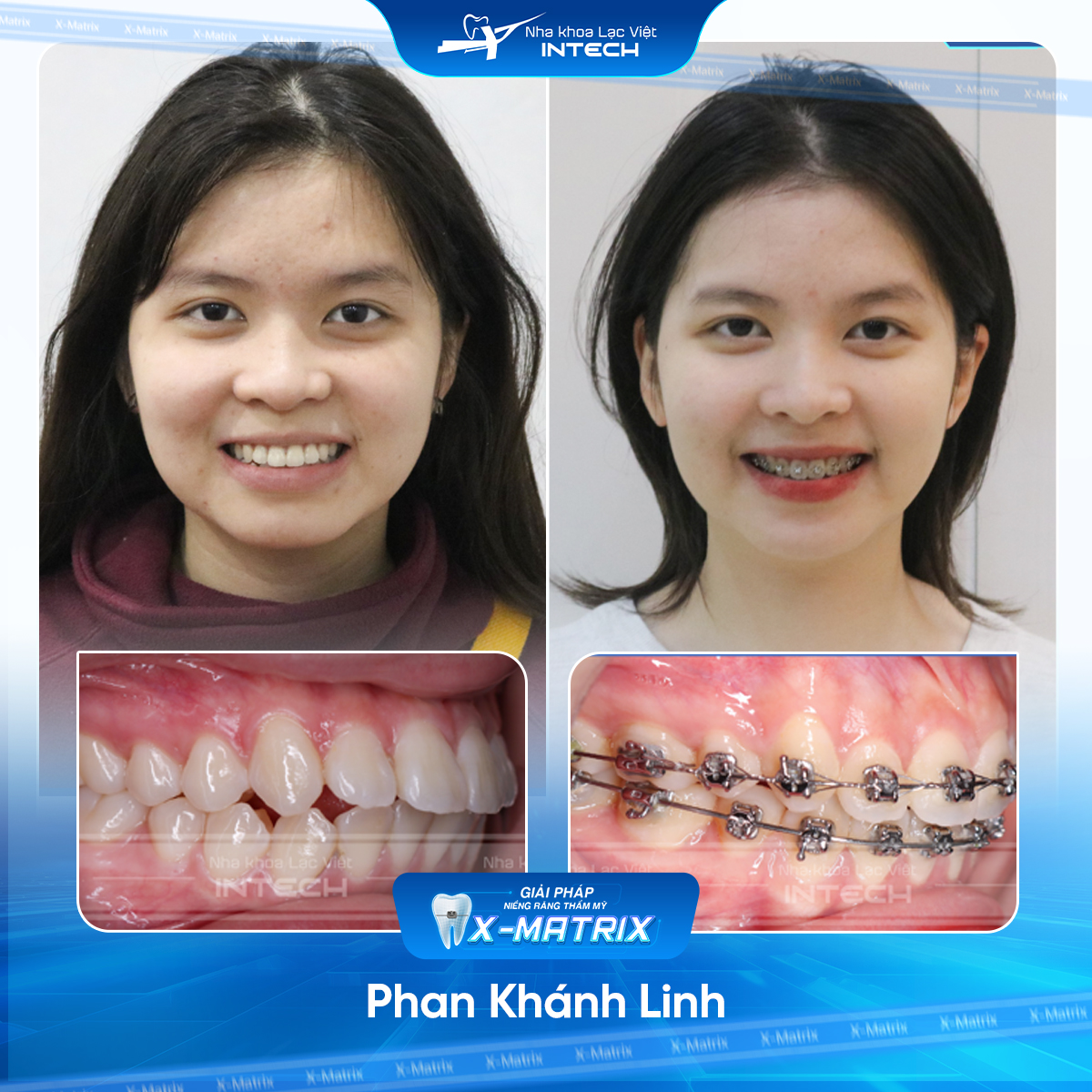 Bác sĩ niềng răng Phạm Dung | Thông Tin - Đặt Lịch Bác Sĩ 16 Bac si nieng rang Pham Dung nha khoa Lac Viet Intech