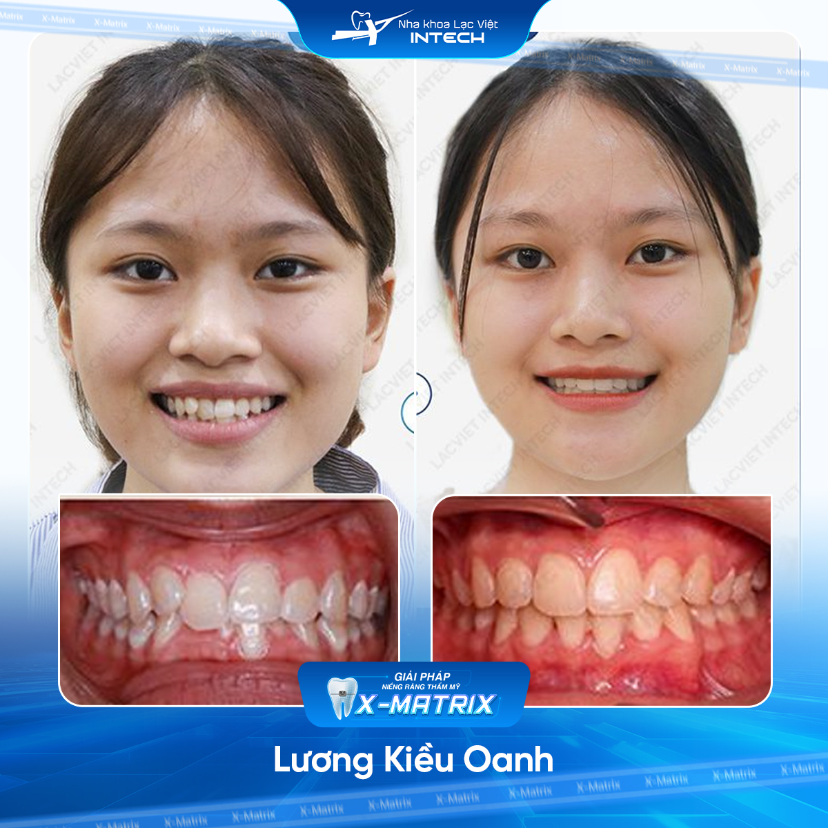 Bác sĩ niềng răng Phạm Dung | Thông Tin - Đặt Lịch Bác Sĩ 15 Bac si nieng rang Pham Dung nha khoa Lac Viet Intech