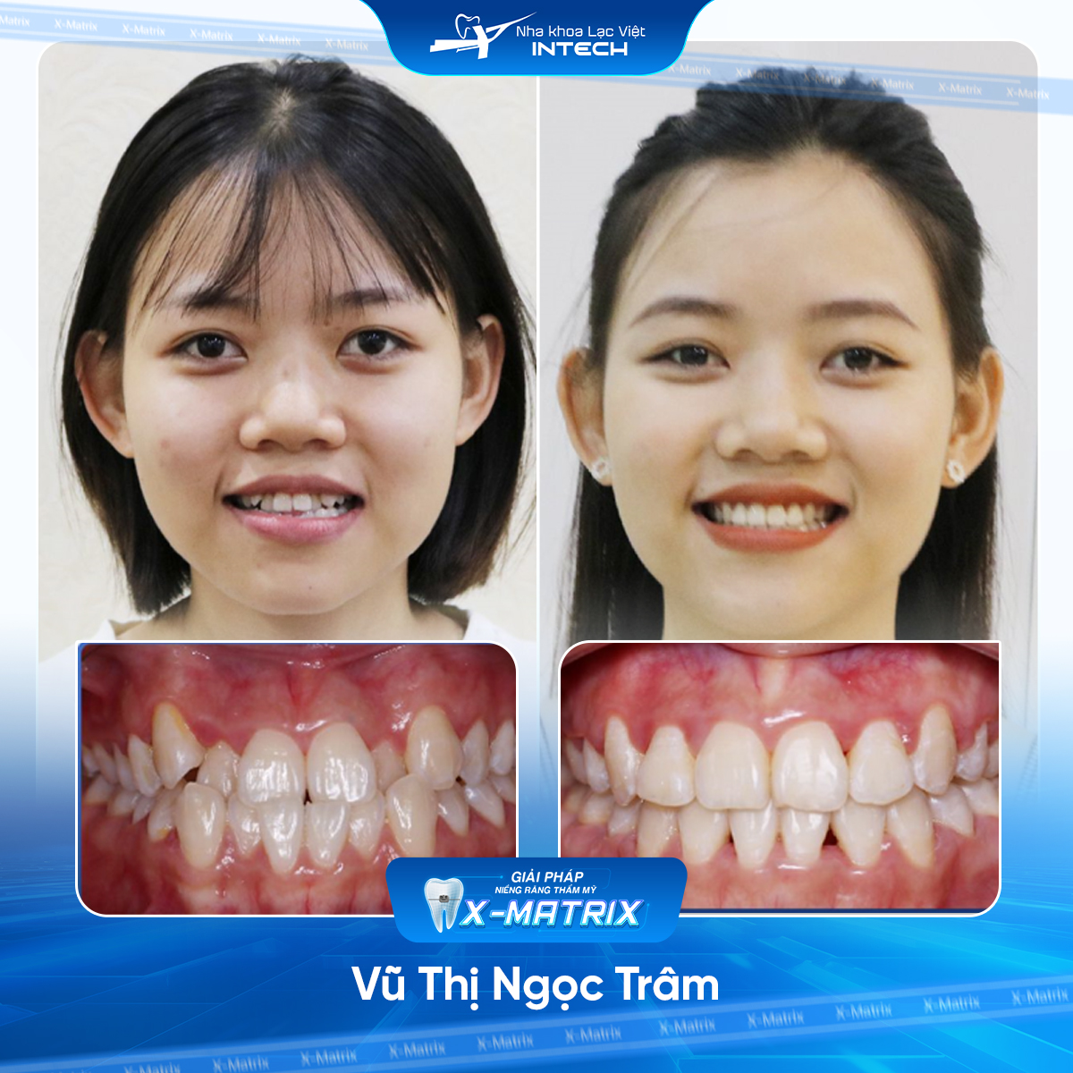 Bác sĩ niềng răng Phạm Dung | Thông Tin - Đặt Lịch Bác Sĩ 14 Bac si nieng rang Pham Dung nha khoa Lac Viet Intech